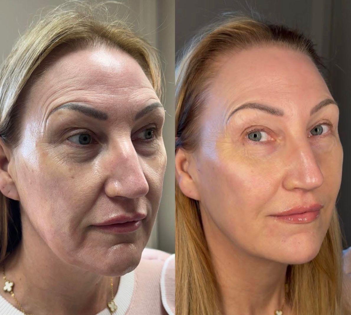 Before and after aesthetic treatment results