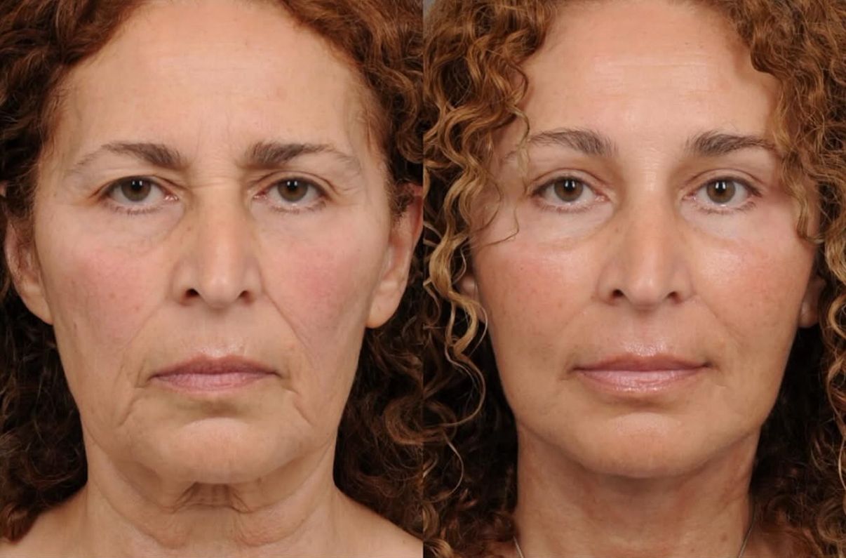 Before and after aesthetic treatment results